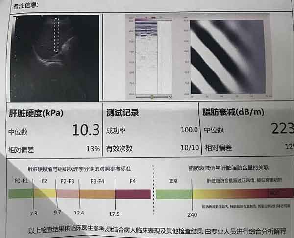 郑州哪家医院治疗肝硬化比较好