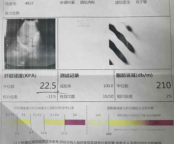 郑州哪家医院治疗肝硬化比较好